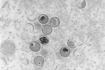 CDC Mỹ phát hiện hai bệnh nhi đầu tiên mắc bệnh đậu mùa khỉ